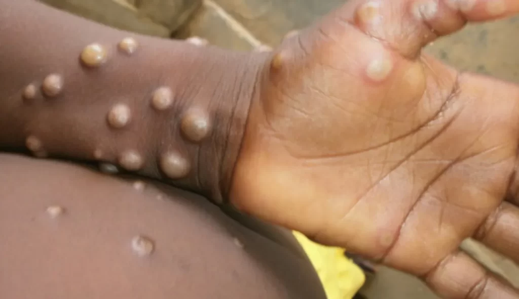 Europe, Canada and US hit by the rare Monkeypox virus