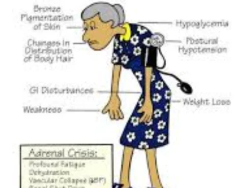 Addison's Disease - Causes, Symptoms and Treatment