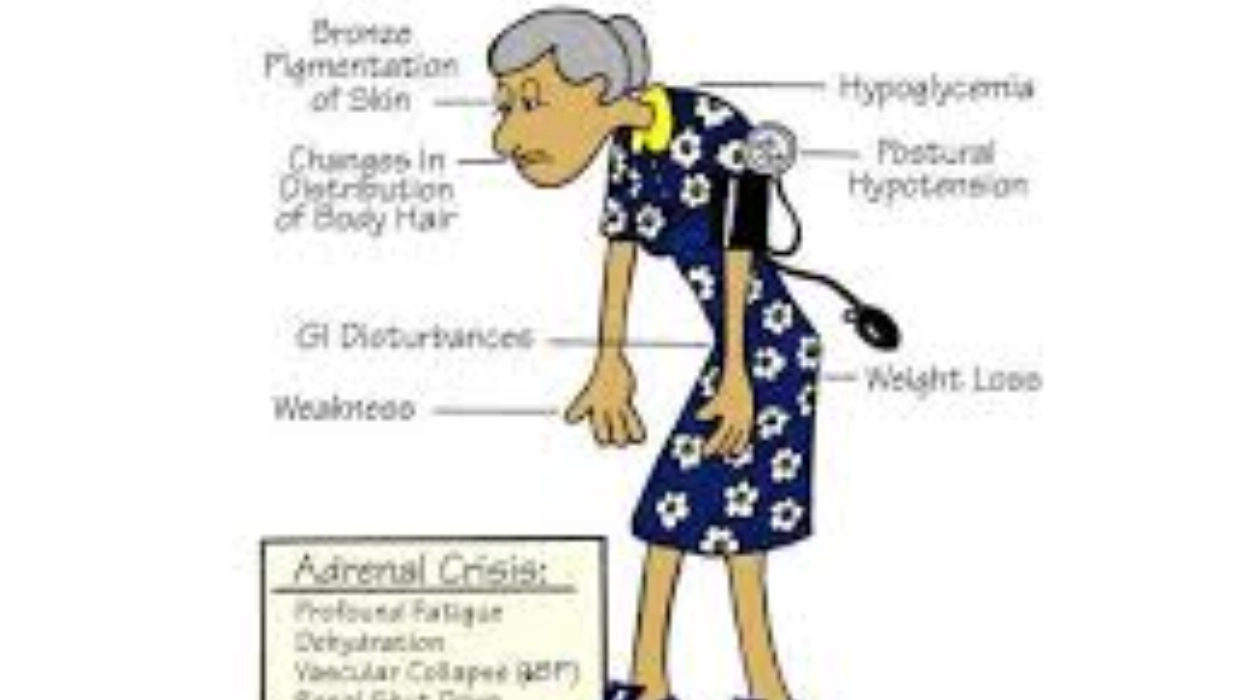 Addison's Disease - Causes, Symptoms and Treatment