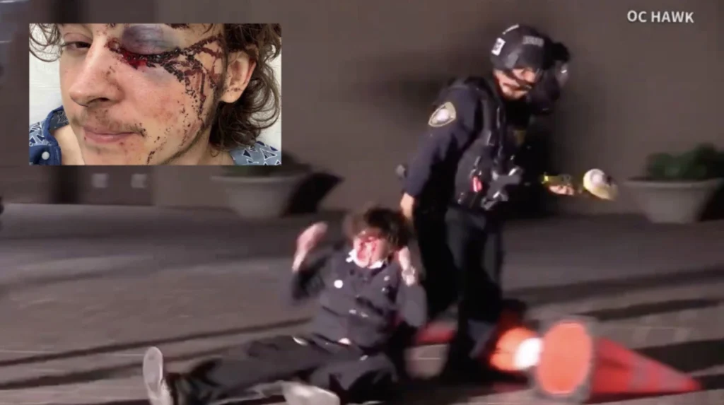 Second anti-ICE protester blinded by Federal projectile during Santa Ana demonstration