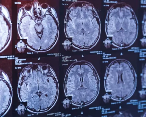 UK health regulator denies Alzheimer’s drug despite approval