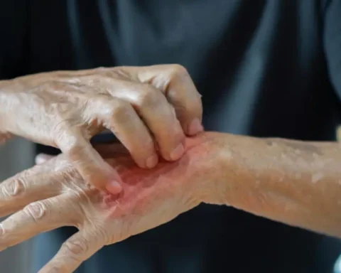 UK witnesses surge in scabies and measles hospitalizations